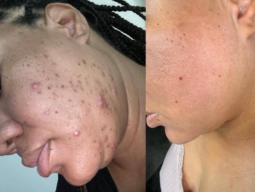 Authentic Dani Esthetics hormonal-acne client comparison: before on the left and after on the right